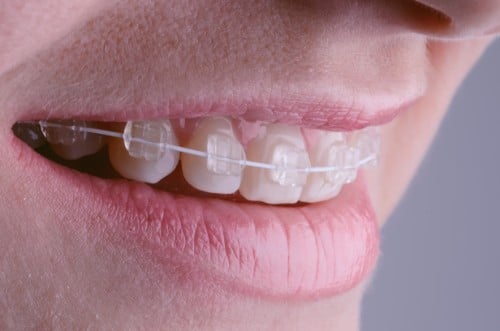 clear braces with purple bands