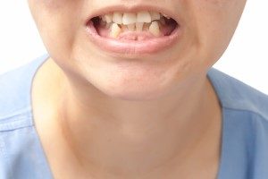 crowding - Common Childhood Dental Problems Orthodontists Associates of WNY