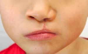 Cleft Lip and Palate Treatment in Buffalo, NY Free Consultation