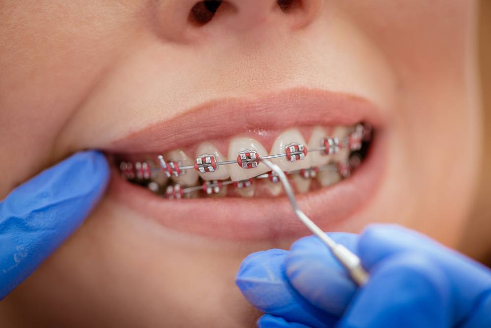 All You Need to Know About Orthodontic Braces