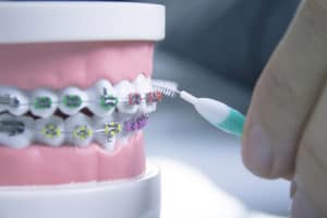 Two Phase Orthodontic Treatment Orthodontists Associates of WNY