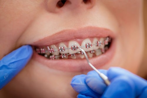 Cost of Orthodontic Treatment Cost of Braces
