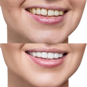Crooked Teeth Treatment Braces for All Ages Orthodontists in Buffalo NY