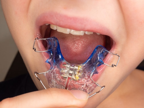 Dental Expander Palatal Expanders Orthodontists in Buffalo, NY