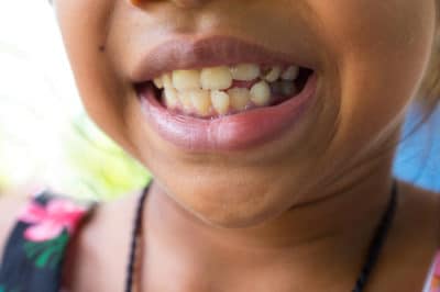 Dental Issues Parents Should Check Orthodontists Associates of WNY