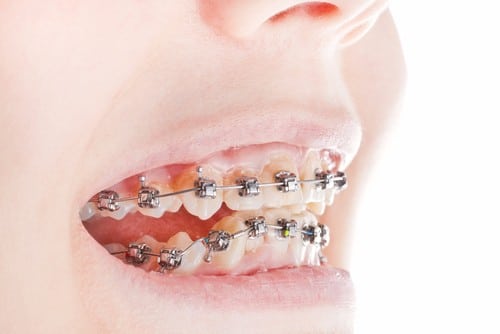 Bad Habits to Avoid with Braces WNY Orthodontists Free Consultation