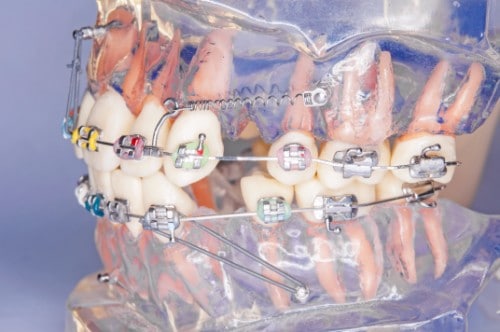 How Braces Actually Work