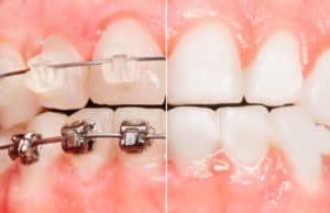 Types of Braces Invisalign Options Orthodontists Associates of WNY
