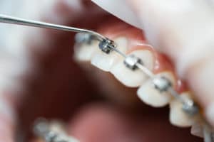 Questions About Braces in Buffalo, NY Orthodontists Associates of WNY