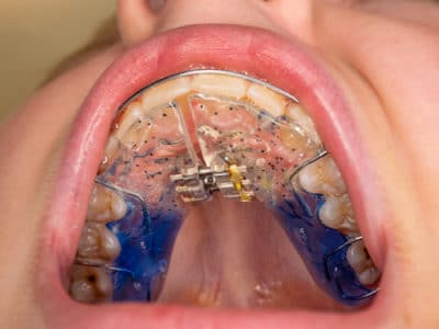 Palatal Expanders FAQ - Everything You Need to Know