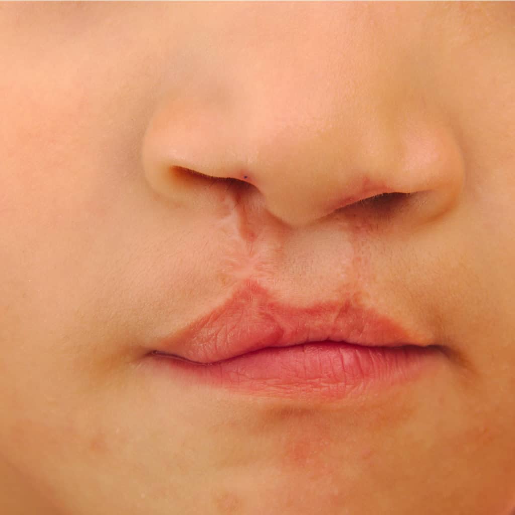 Cleft Lip and Palate Repair in Buffalo Orthodontists Associates of WNY