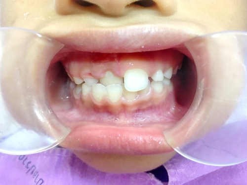 Fixing a Crossbite With Orthodontics Orthodontist in Buffalo, NY