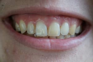 How To Fix A Gummy Smile | Orthodontist in Buffalo | Free Consultation