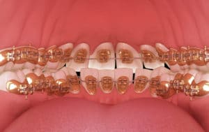 Lingual,Braces,System.,3d,Illustration,Concept,Of,Golden,Braces - Ideal Bite Perfect Teeth Alignment Orthodontists Associates of WNY