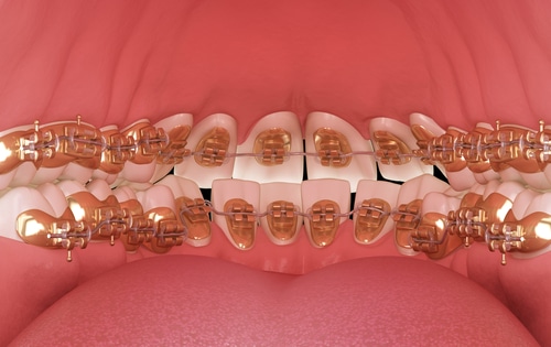 Lingual,Braces,System.,3d,Illustration,Concept,Of,Golden,Braces - Ideal Bite Perfect Teeth Alignment Orthodontists Associates of WNY