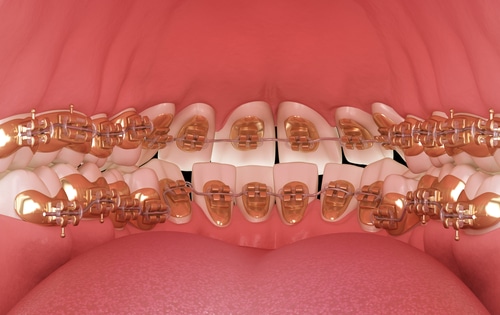 Perfect clearance teeth alignment