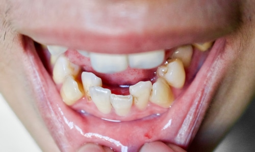 Crowded Teeth Treatment Orthodontists Associates of WNY