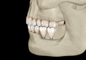 Jaw Misalignment Treatment Options