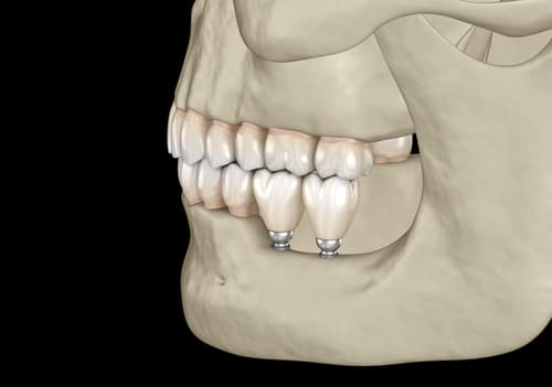 Jaw Misalignment Treatment Options