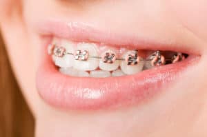 Dental Insurance with Braces