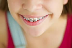 Do Braces Hurt What to Expect WNY Orthodontists Free Consultation
