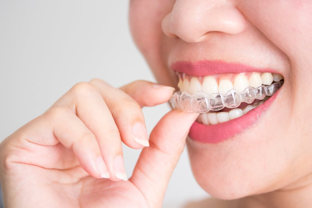 Common Orthodontic Issues Buffalo Orthodontists Free Consultations