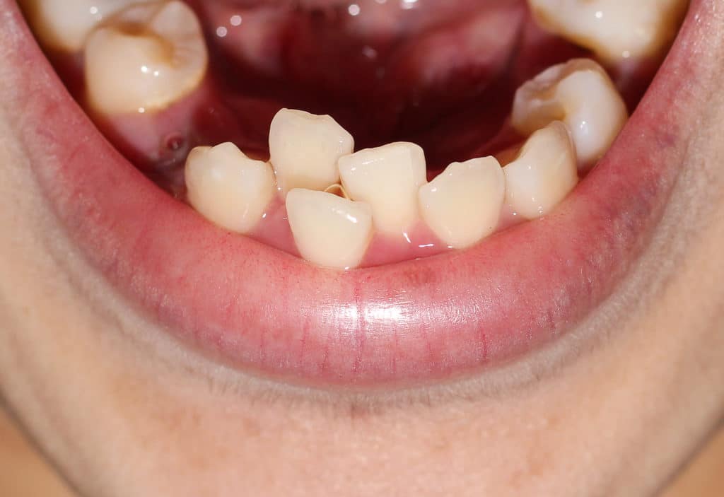 Fix Crowding of Teeth WNY Orthodontists Free Consultations Call Us