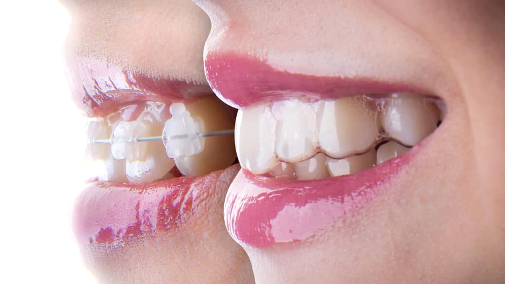 Advantages of Clear Braces vs Traditional Braces