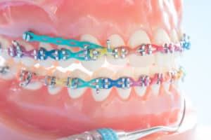 Orthodontic Elastics FAQs WNY Orthodontists Your Free Consultation