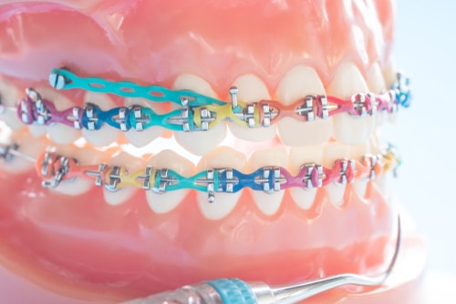 Orthodontic Elastics FAQs, WNY Orthodontists