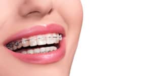Straighten Teeth with These Treatments Free Consultation Orthodontists