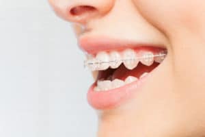 Types of Clear Braces to Consider WNY Orthodontists Free Consultation