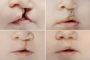 Cleft Lips Causes, Risks & Treatments WNY Orthodontists Free Consult