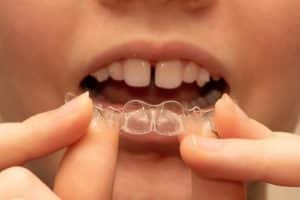 Cost of Invisalign | Invisible Braces | Orthodontists Associates of WNY