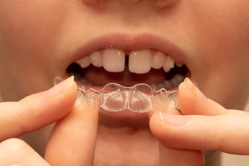 Cost of Invisalign | Invisible Braces | Orthodontists Associates of WNY