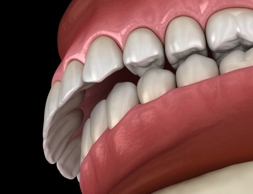 Jaw Bite Alignment Treatment in Buffalo, NY Orthodontists Associates