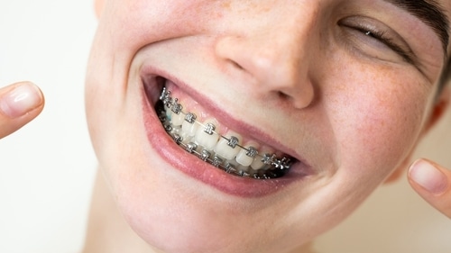 Metal Braces: Learn About The Surprising Benefits of Metal Braces