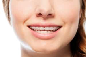 Orthodontic Treatment for Kids