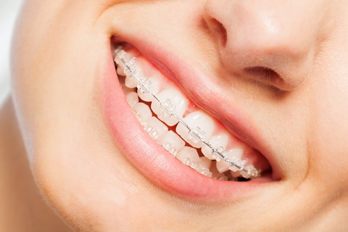 Traditional Braces vs. Other Orthodontic Treatment Options