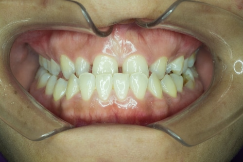 Underbite Treatment Options - Orthodontists Associates of WNY