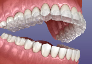 Average Price for Braces in Buffalo, NY | Get a Free Consultation