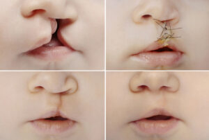 Craniofacial Abnormalities in Children | Free Screening in Buffalo