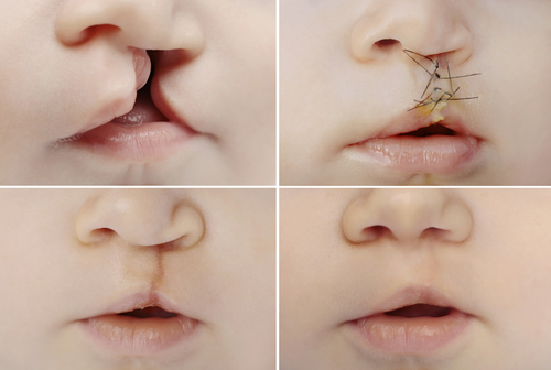 Craniofacial Abnormalities in Children | Free Screening in Buffalo