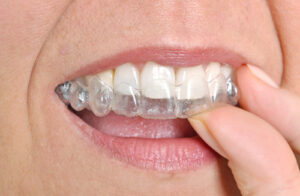 Invisalign for Overbite Correction | Free Consultation in Buffalo, NY