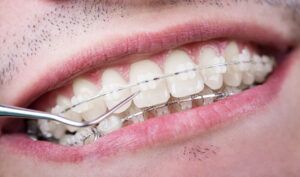 Clear Braces vs. Metal Braces in Buffalo, NY | Book a Free Consult