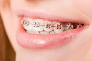 The Best Orthodontist in Hamburg, NY | Book a Free Screening