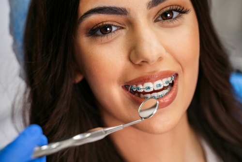 Traditional Metal Braces in Buffalo, NY | Free Orthodontics Consult