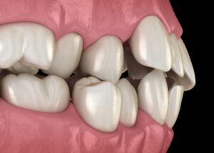 Best Orthodontist in East Aurora, NY | Book a Free Screening