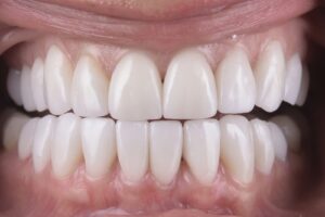 Correct Bite Alignment in Western New York | Free Consultation