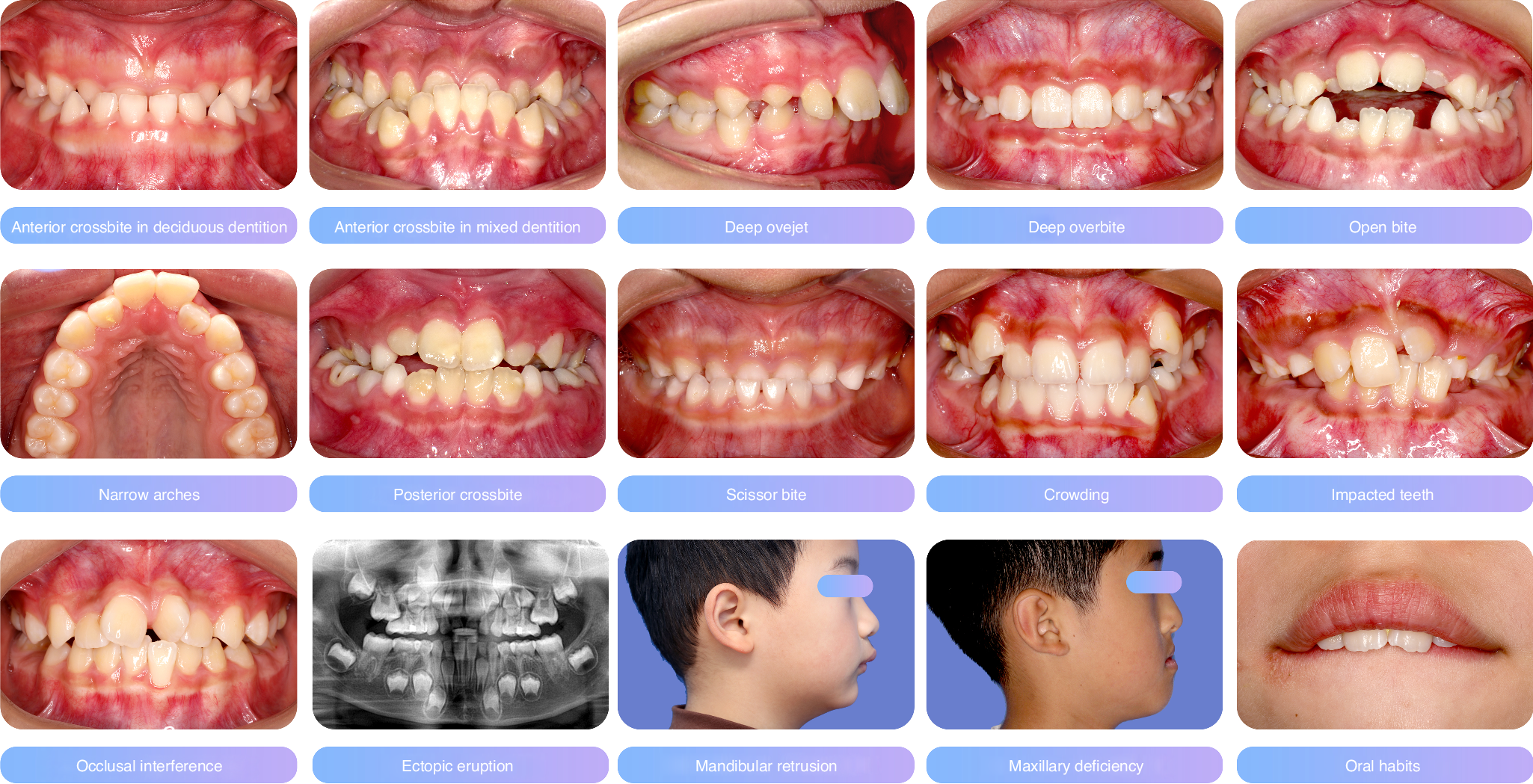 Dentofacial Orthopedic Devices in WNY | Free Consultation